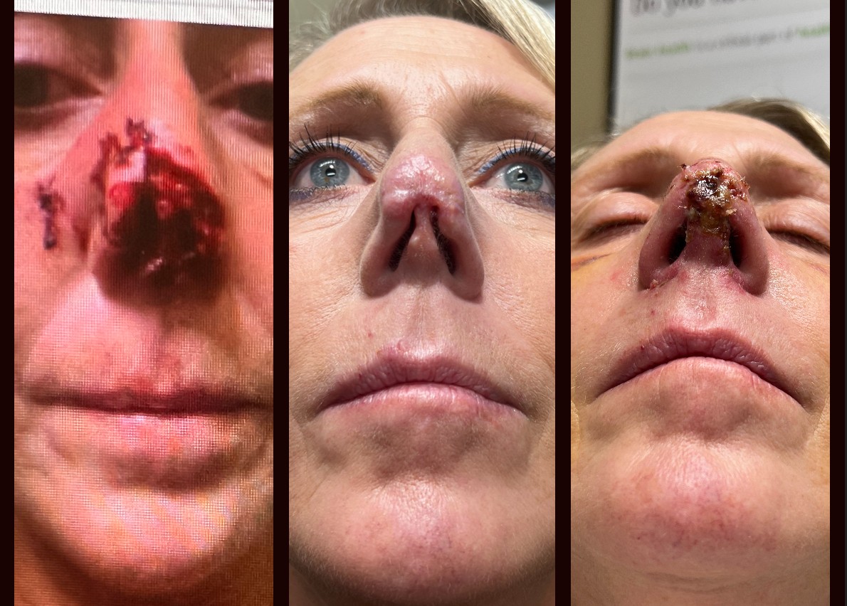 defect reconstruction on nose before and after