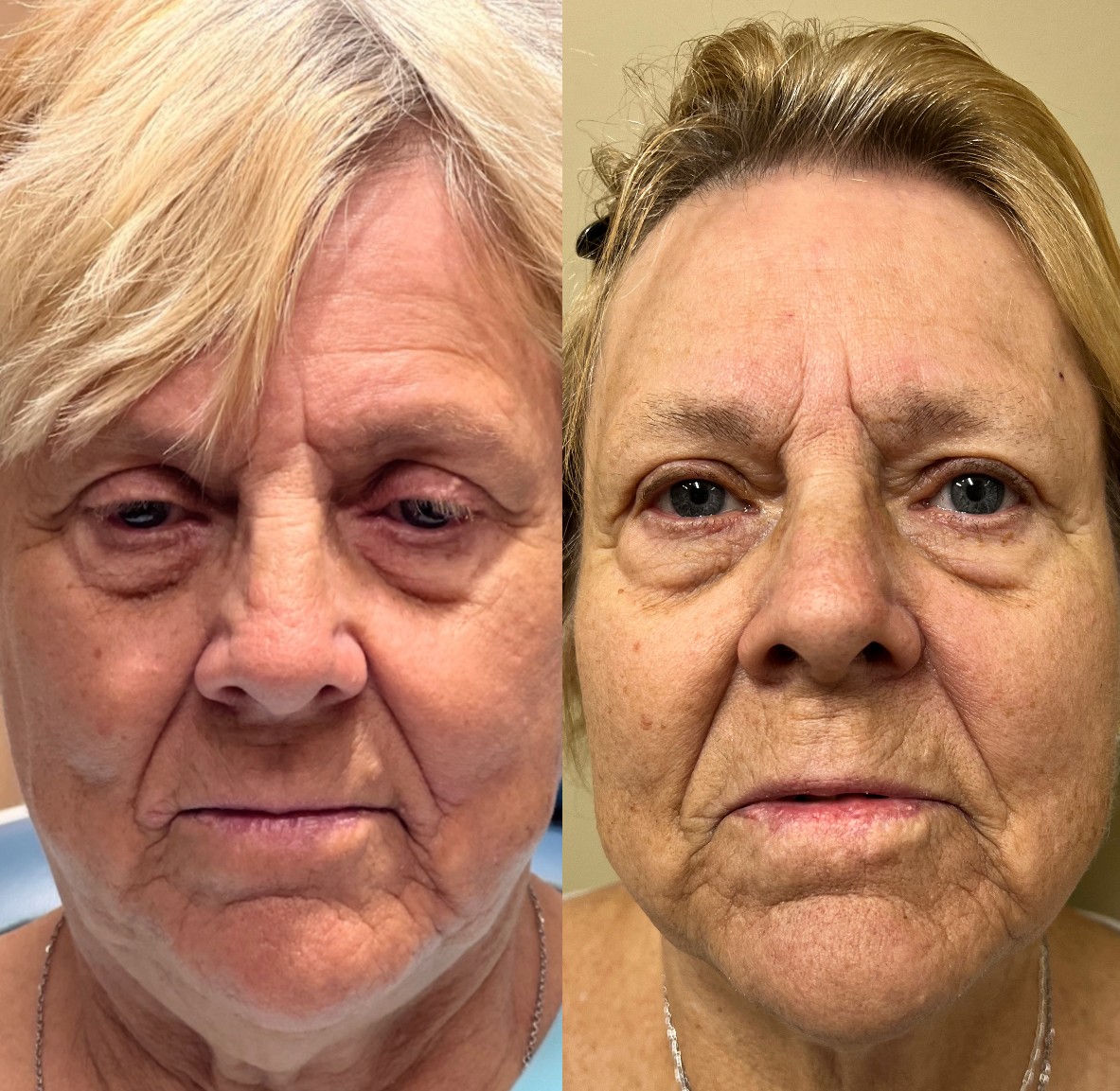 eyelid and brow lift