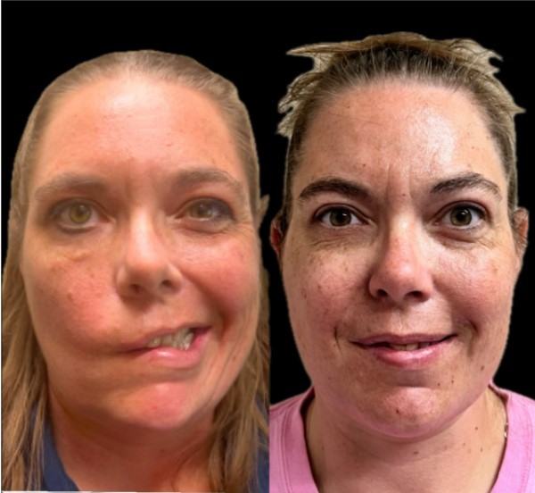 facial paralysis before and after surgery