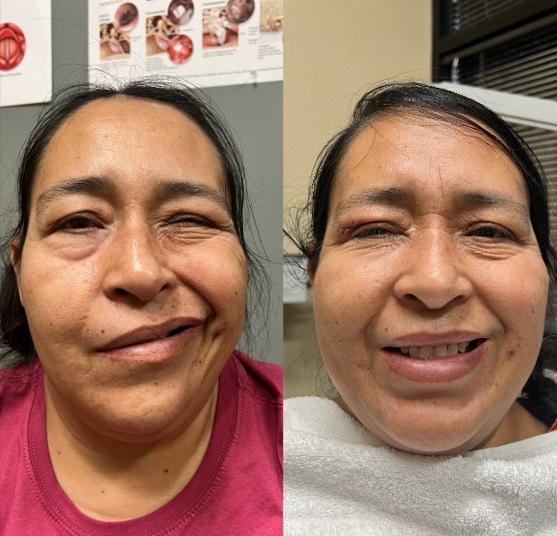 facial paralysis before and after