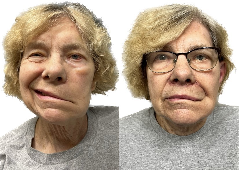 facial paralysis before and after