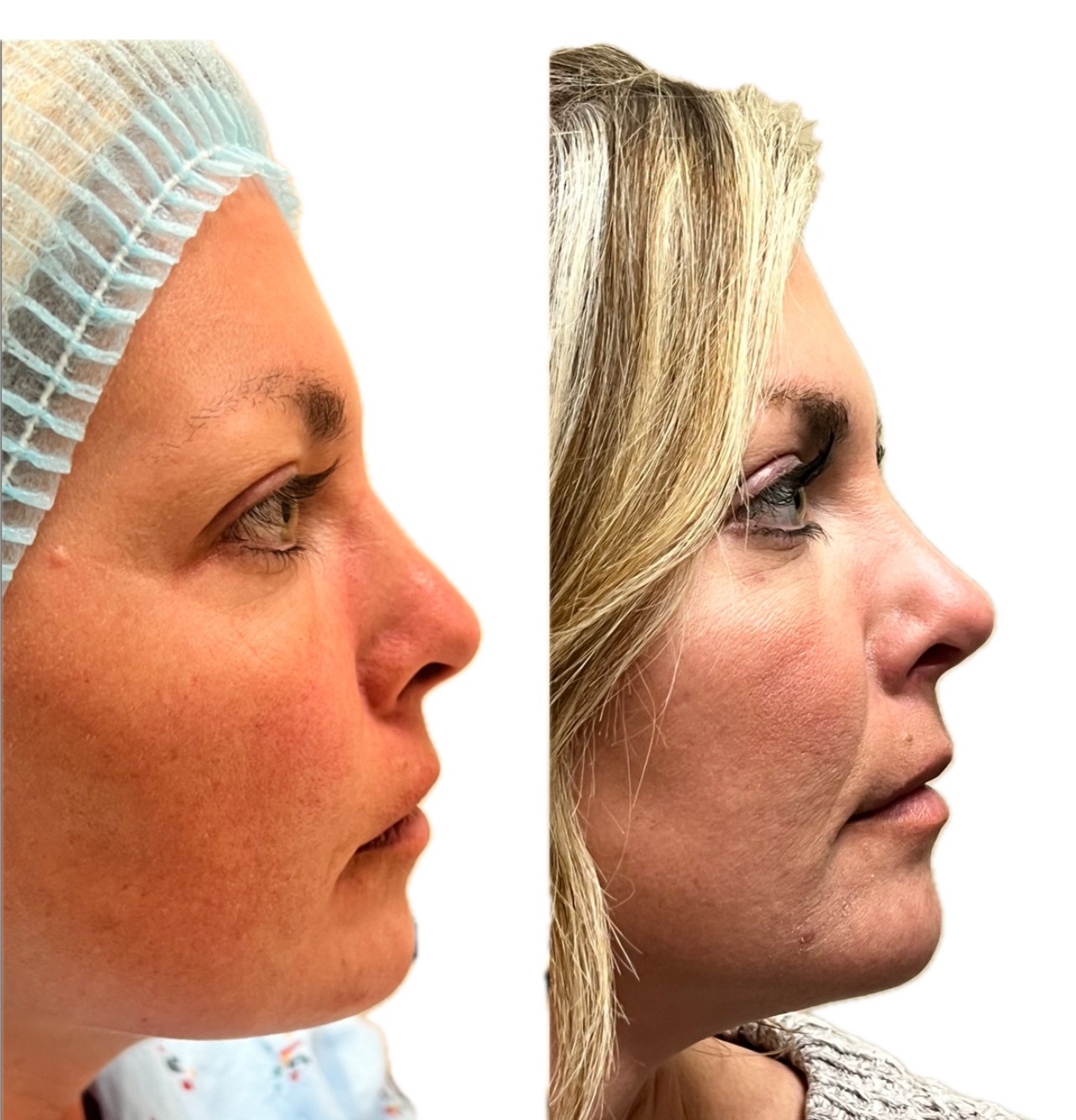 nose surgery before and after