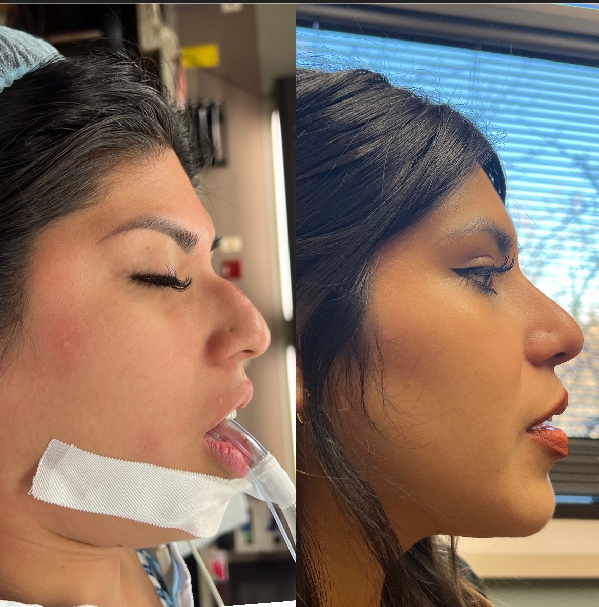 nose surgery before and after